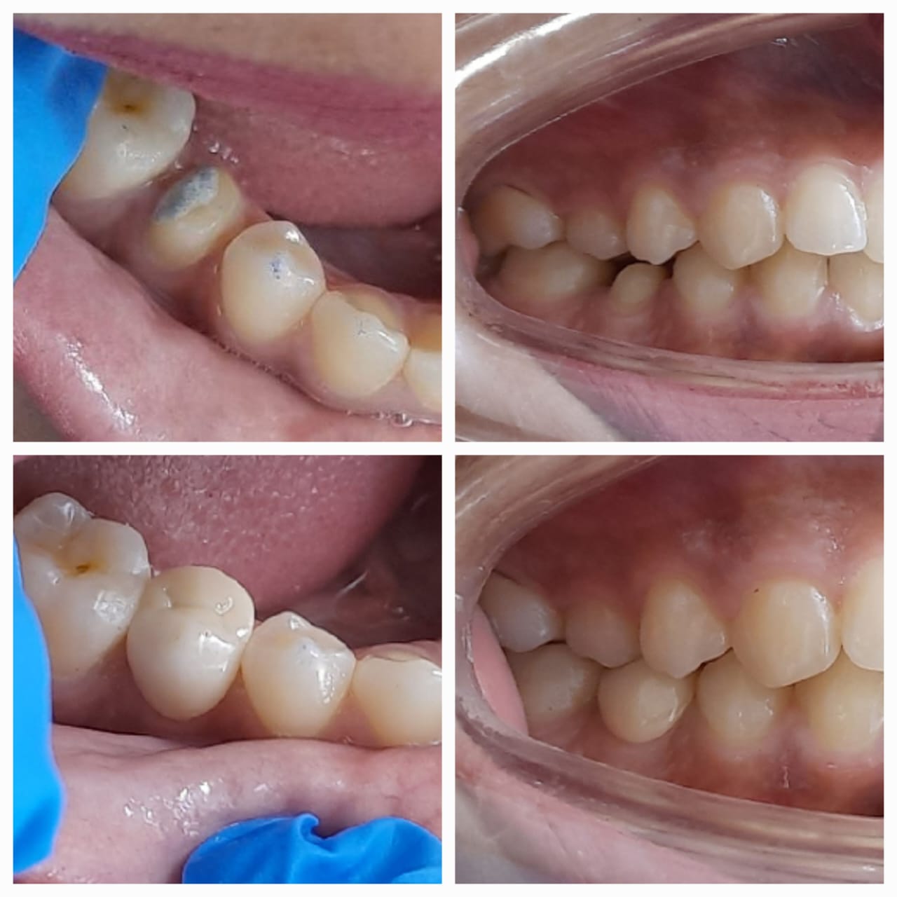 Best Jaw Point Treatment
